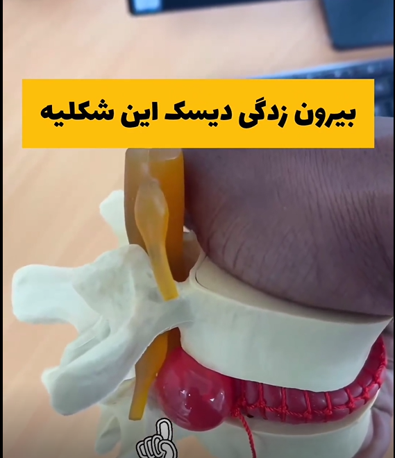 بیرون زدگی دیسک کمر